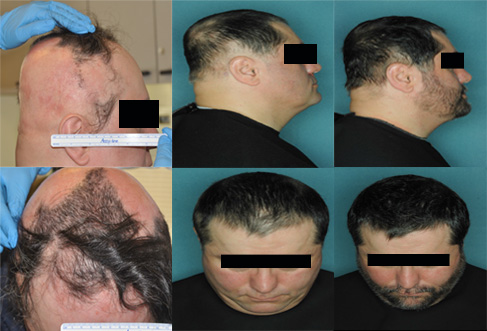 Le fasi di ricrescita dei capelli con il trattamento a base di ruxolitinib