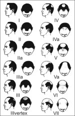 The Norwood Hamilton classification of male balding defines two major patterns and