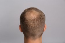 crown-balding.jpg