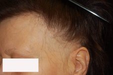 alopecia-fibrosante-frontale-5-1440x955.jpg