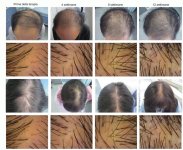 Microneedling scaled