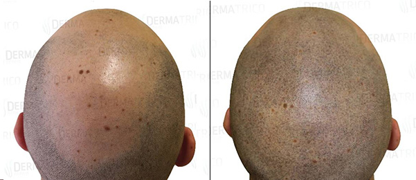 Tricopigmentazione: prima-dopo intervento effetto rasato