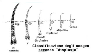 Gradi di displasia nell'alopecia andogenetica