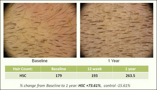 HSC: Hair Stimulating Complex - trattamento mesoterapico calvizie della Histogen Inc.