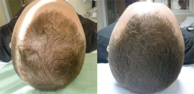 Tricopigmentazione: prima-dopo intervento effetto punto pelo