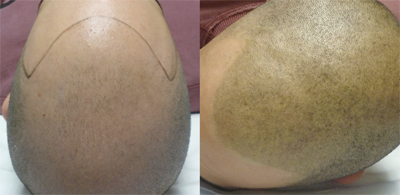 Tricopigmentazione: prima-dopo intervento effetto rasato