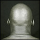 l'alopecia universalis è una forma estrema di alopecia areata