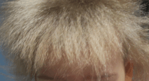 sindrome dei capelli impettinabili