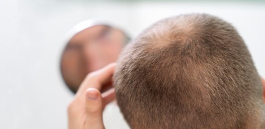 che cos'è l'alopecia areata