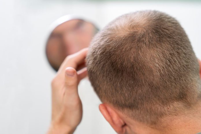 che cos'è l'alopecia areata