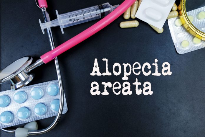 Terapie Alopecia areata: quali sono?