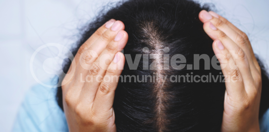 alopecia androgenetica femminile
