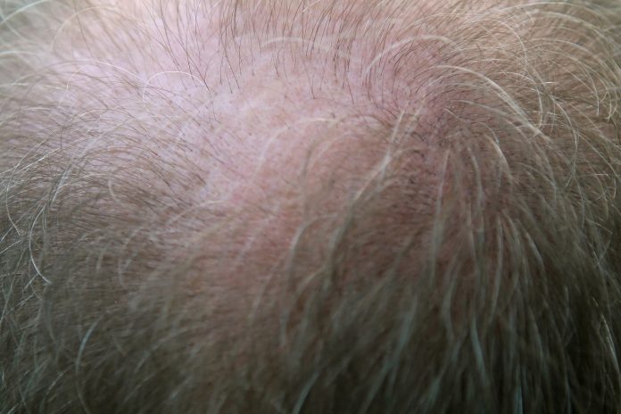 alopecia e infiammazione