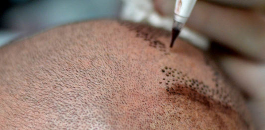 tricopigmentazione caratteristiche generali