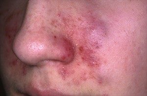 dermatite seborroica al volto durante lo sviluppo