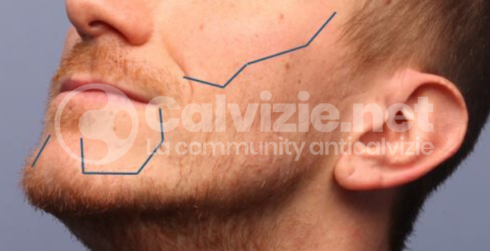 trapianto barba