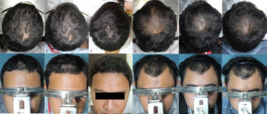 minoxidil 5 orale