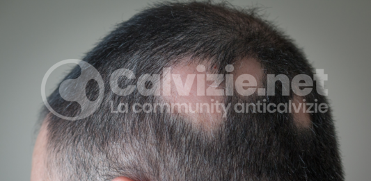 alopecia areata cosa fare