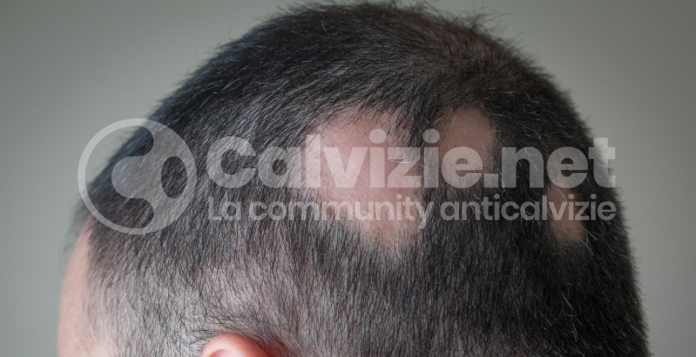 alopecia areata cosa fare