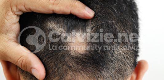 I trattamenti sperimentali alopecia areata: quali sono?
