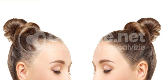 calvizie femminile cure che funzionano