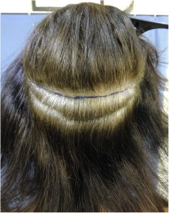 Calvizie femminile: il trapianto di capelli. 