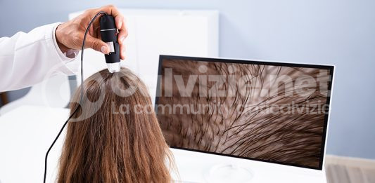 Perdita di capelli diffusa