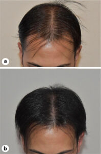 dutasteride microinfusione