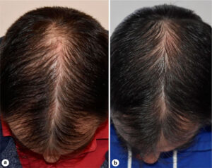 dutasteride microinfusione